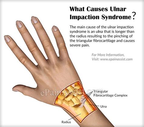 ulnar impaction syndrome symptoms